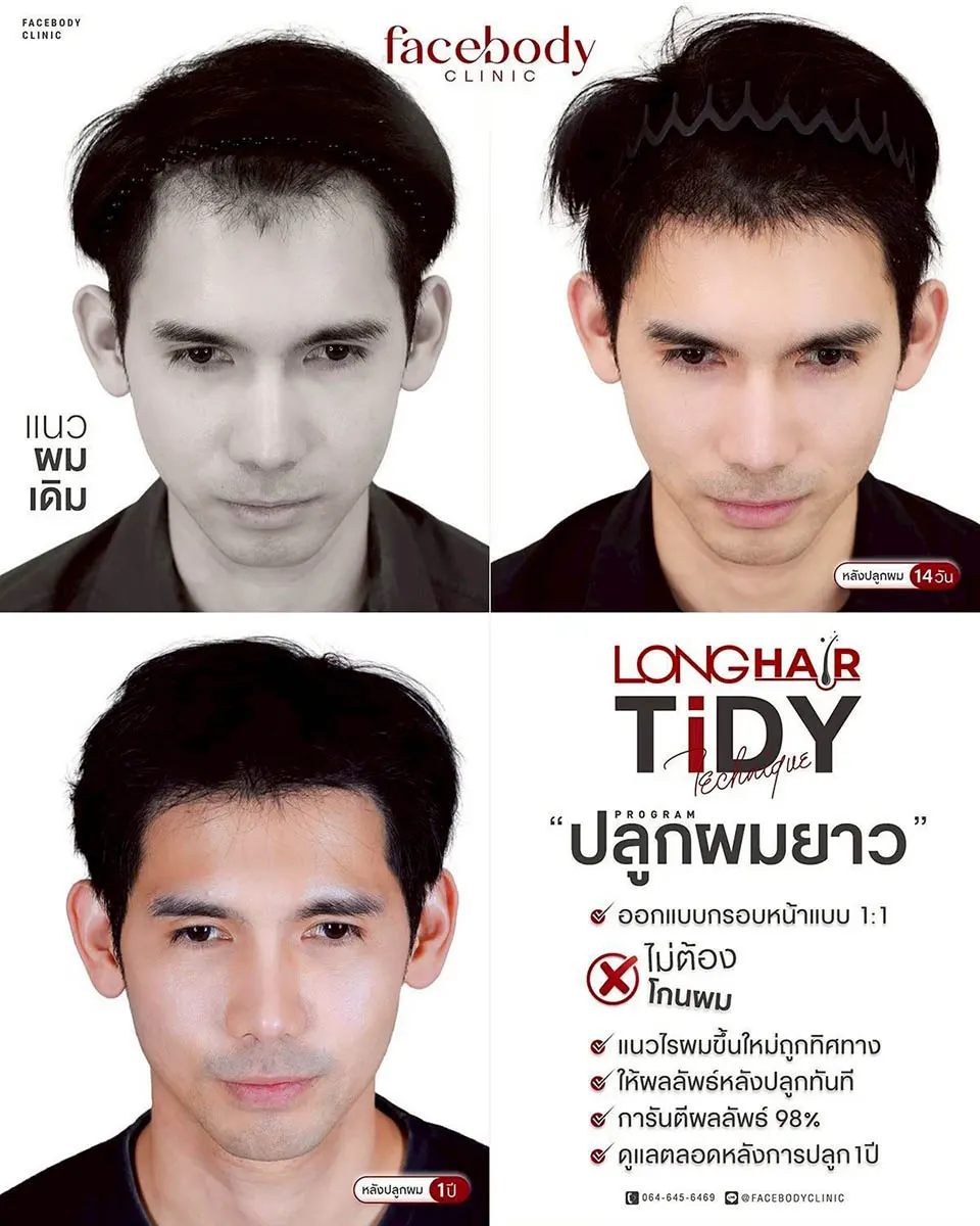 รีวิวปลูกผม Longhair 1 ปี Facebody Clinic