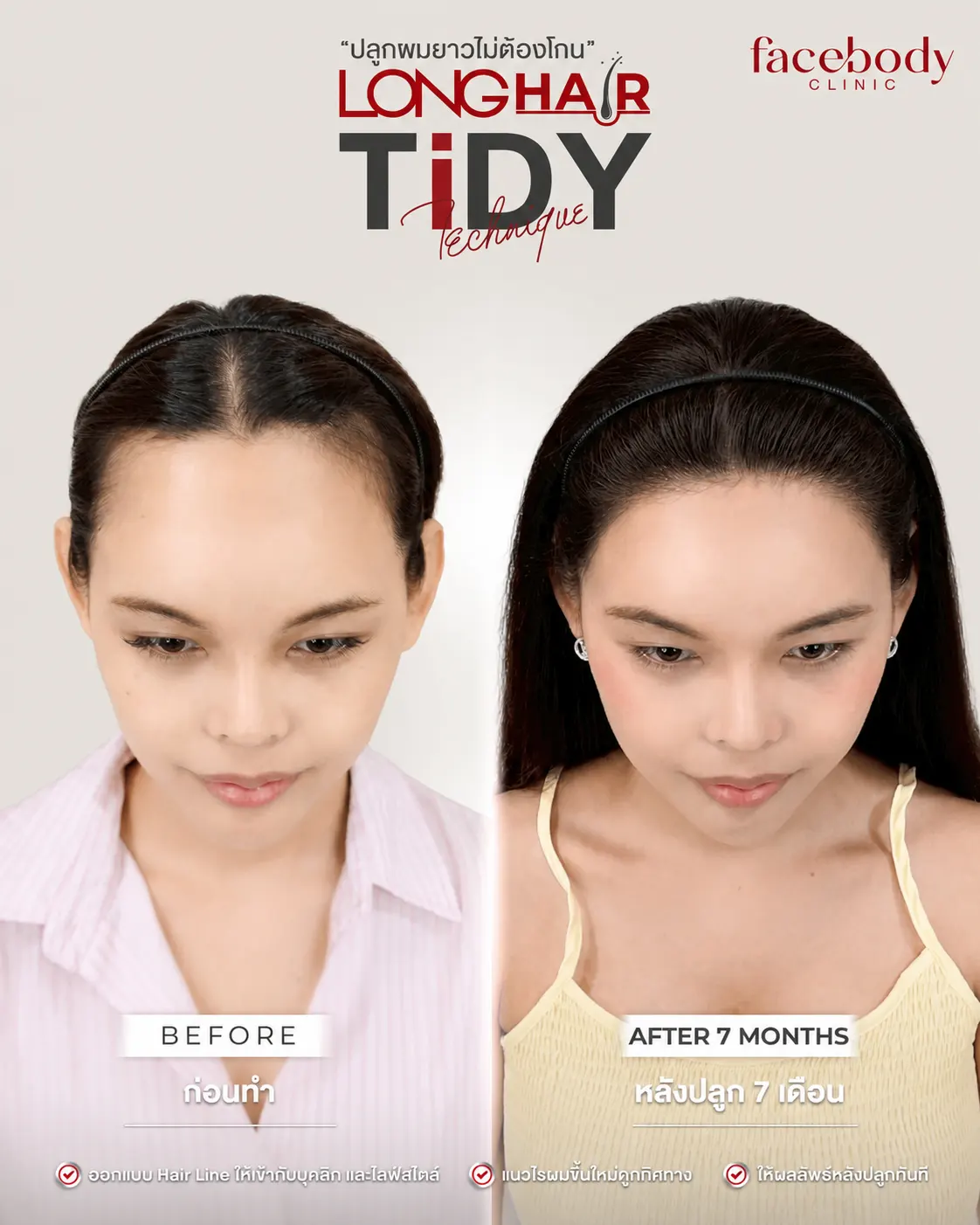 ผลลัพธ์ปลูกผม Long Hair FUE แบบไม่โกนผม