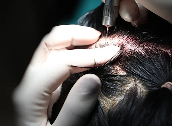 ขั้นตอนที่ 1 การเจาะเก็บกราฟต์ผม (Graft Extraction) สำหรับ Long Hair FUE
