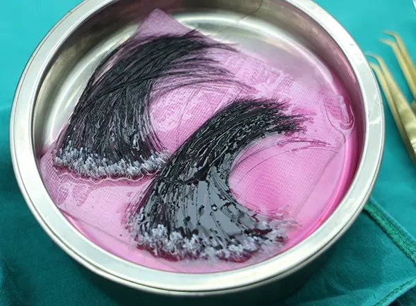 ขั้นตอนที่ 2 การแช่น้ำยาเลี้ยงเซลล์รากผม (Graft Storage Solution) สำหรับ Long Hair FUE