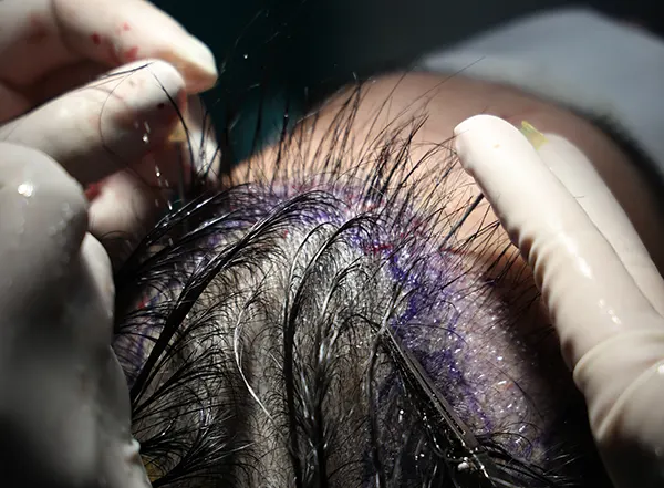 ขั้นตอนที่ 3 การคัดแยกและเตรียมกราฟต์ (Graft Preparation) สำหรับ Long Hair FUE