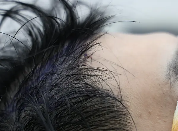 ขั้นตอนที่ 4 การปลูกผมด้วยปากกาปลูกผม (Special Implanter Pen) สำหรับ Long Hair FUE