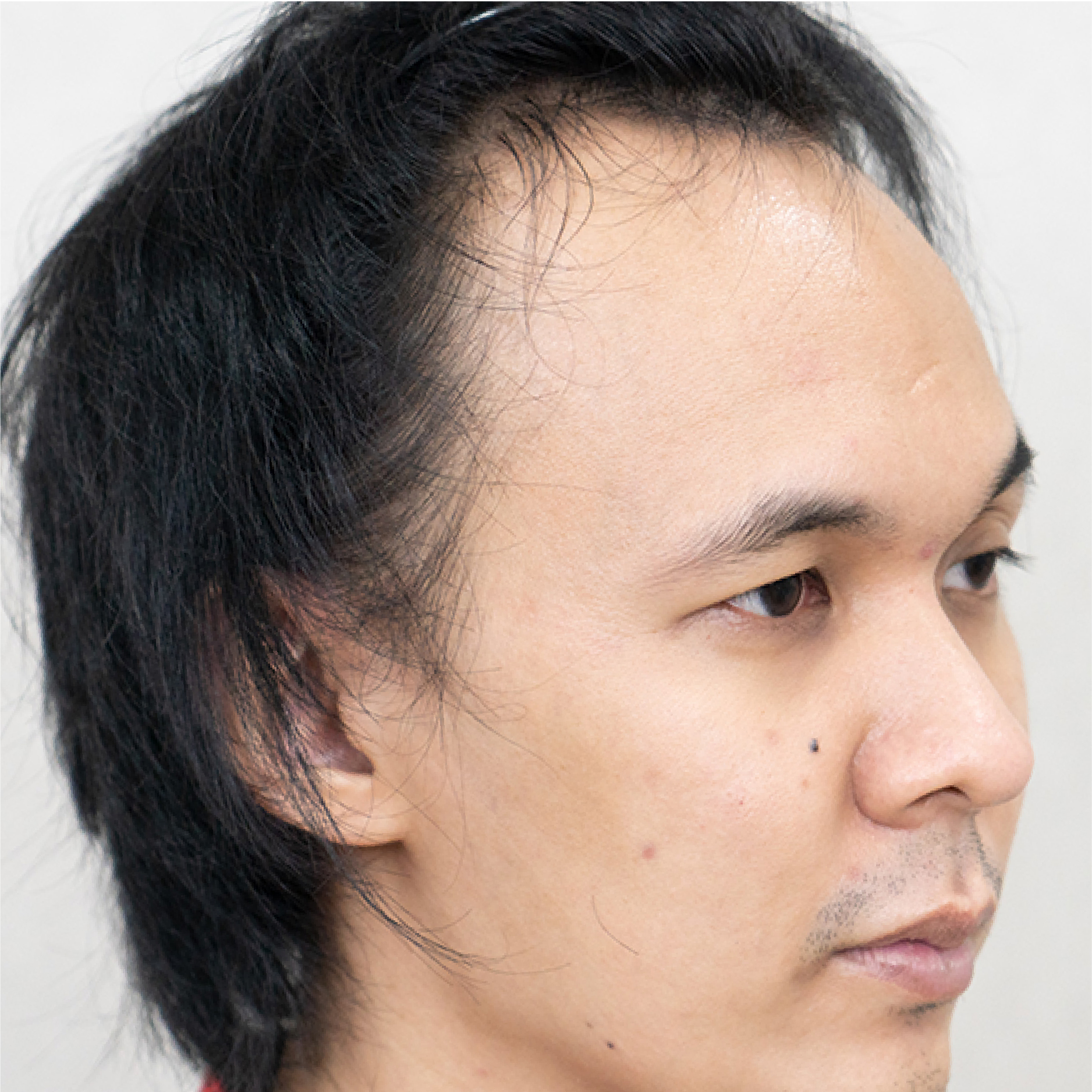 ปลูกผมถาวร FUE