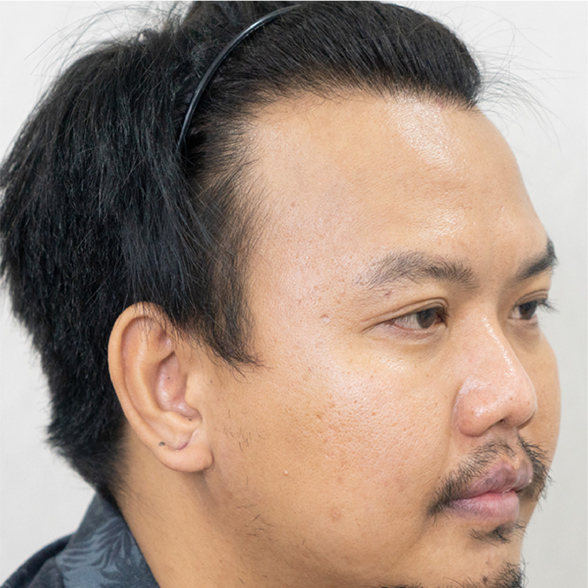 ปลูกผมถาวร FUE