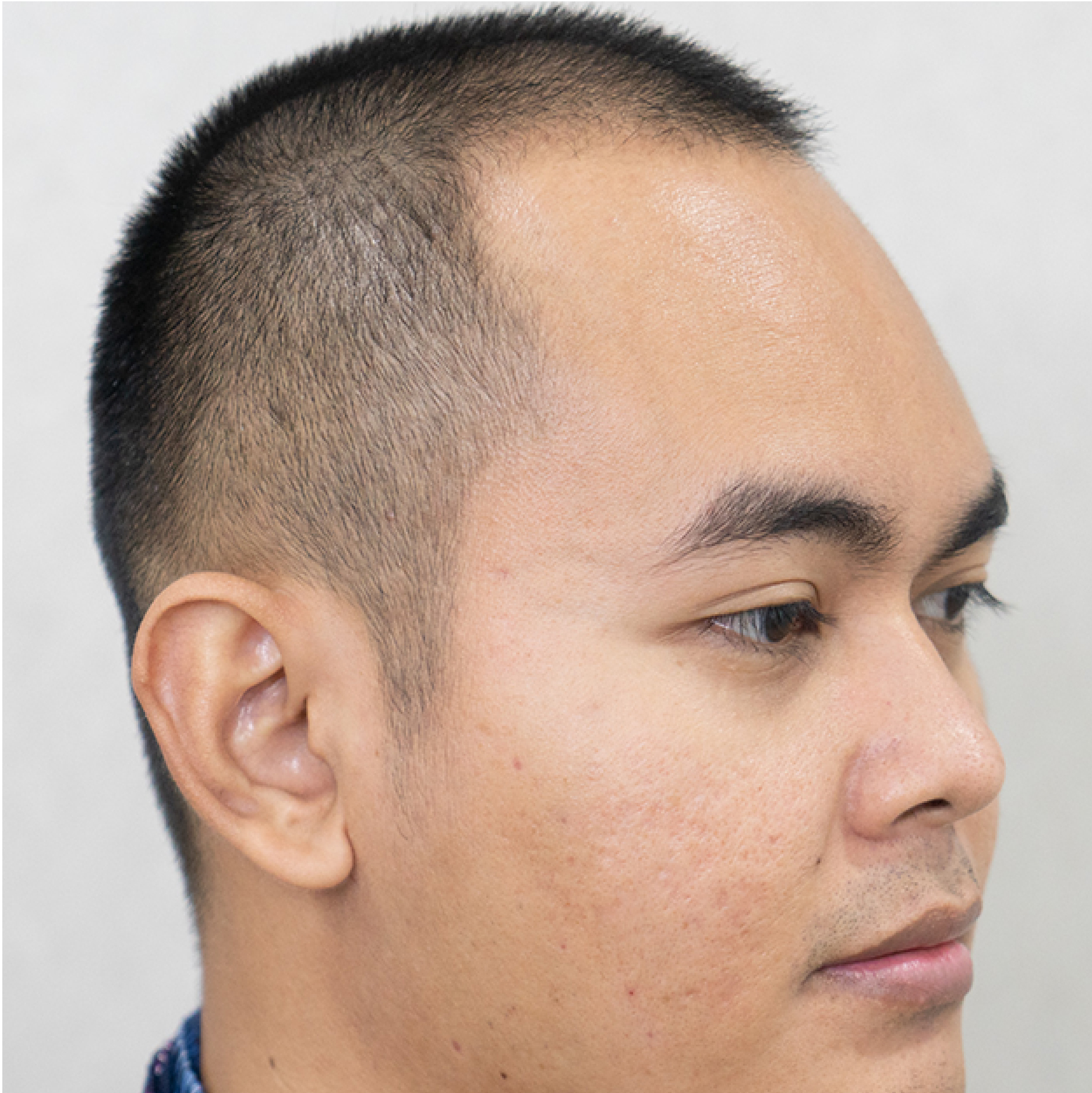 ปลูกผมถาวร FUE