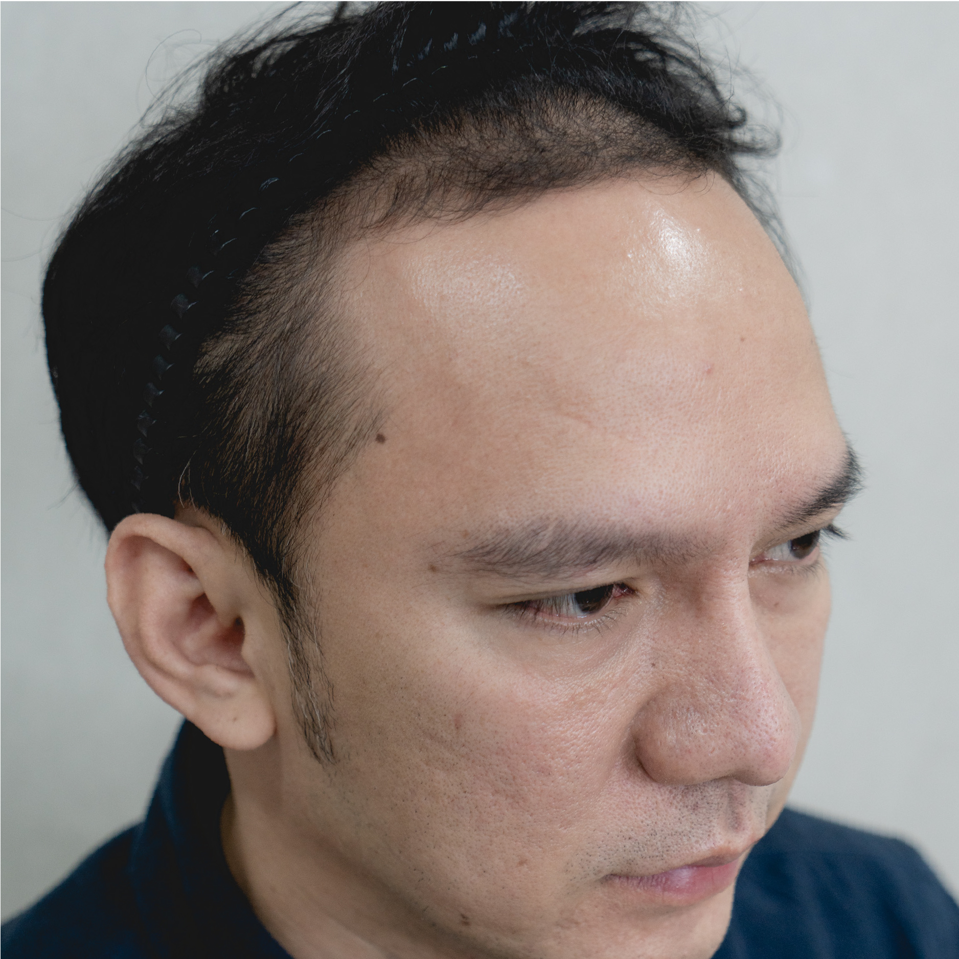 ปลูกผมถาวร FUE
