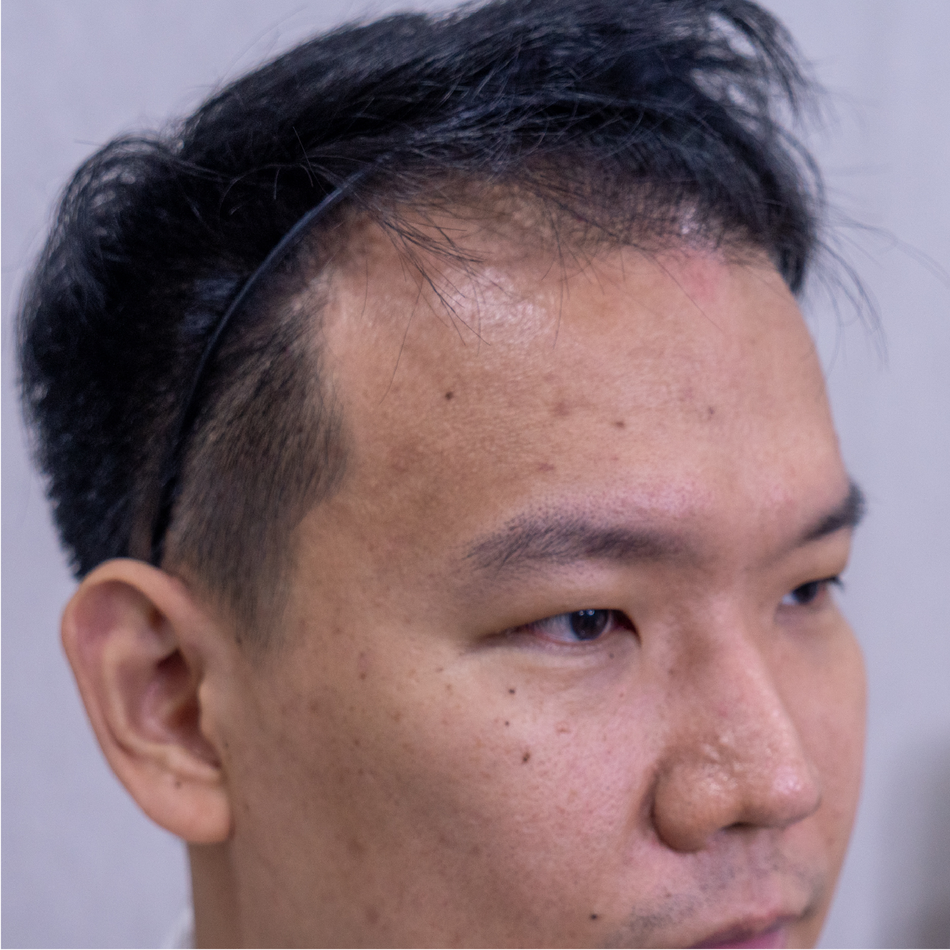 ปลูกผมถาวร FUE