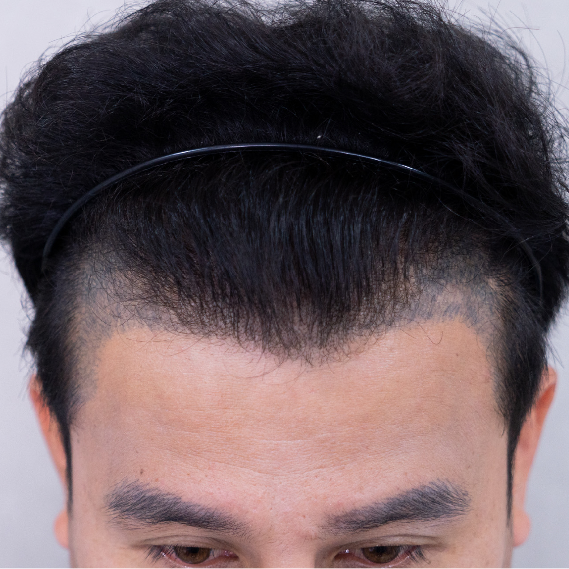 ปลูกผมถาวร FUE
