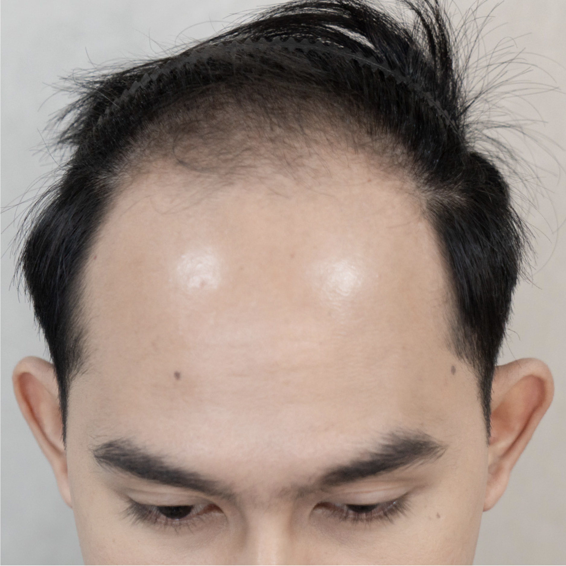 ปลูกผมถาวร FUE