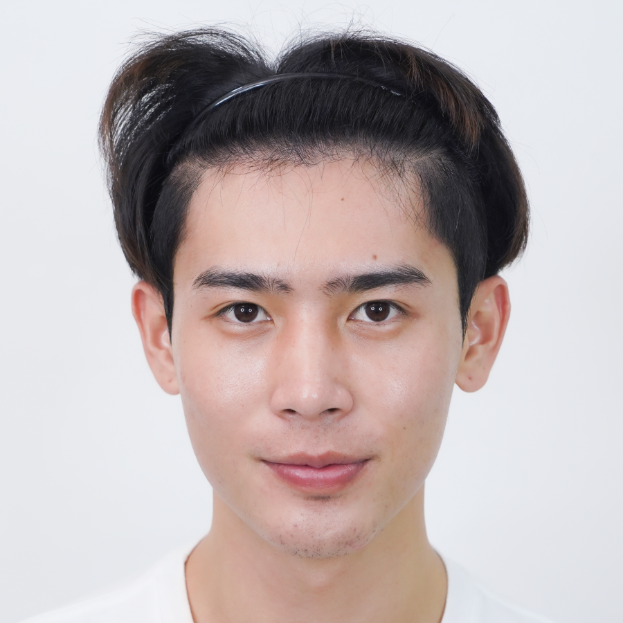 Review-BF-Hair-transplantation-DHI-FUE-A2