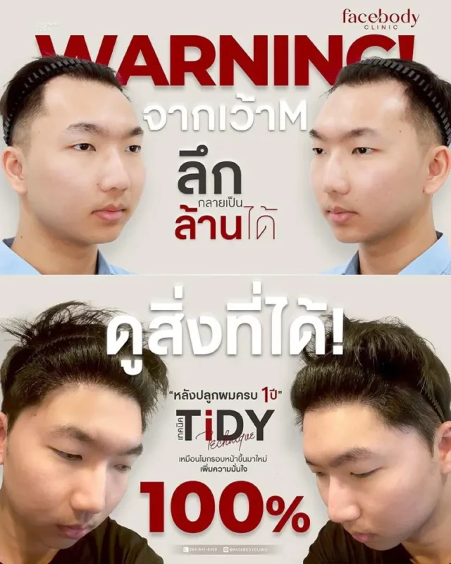 ราคาปลูกผม FUE เริ่มต้น 39,999 บาท โดยแพทย์อเมริกันบอร์ด ABHRS รับประกันดูแลผล 2 ปี ที่ Facebody Clinic กรุงเทพ ปรึกษาฟรี ประเมินกราฟฟรี ผ่อน 0%