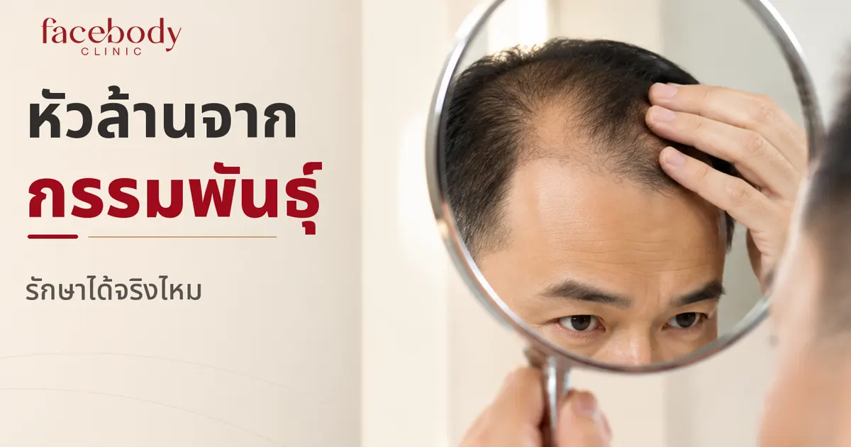 หัวล้านจากกรรมพันธุ์