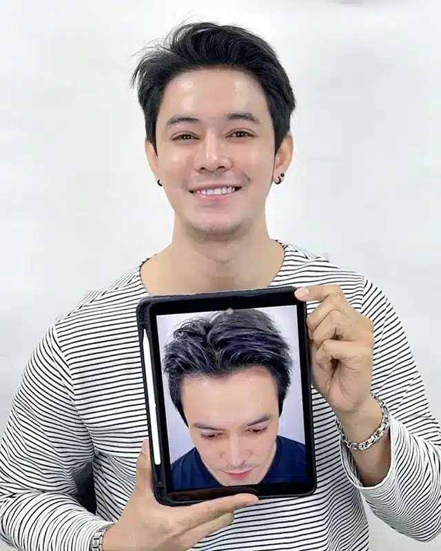 Review 14 Day Male hair transplant (FUE)