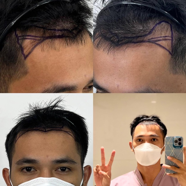 สภาพแนวผมก่อนปลูกของผู้เข้ารับบริการรายนี้ ซึ่งมีแนวผมบริเวณขมับร่นลึกเป็นรูปตัว M