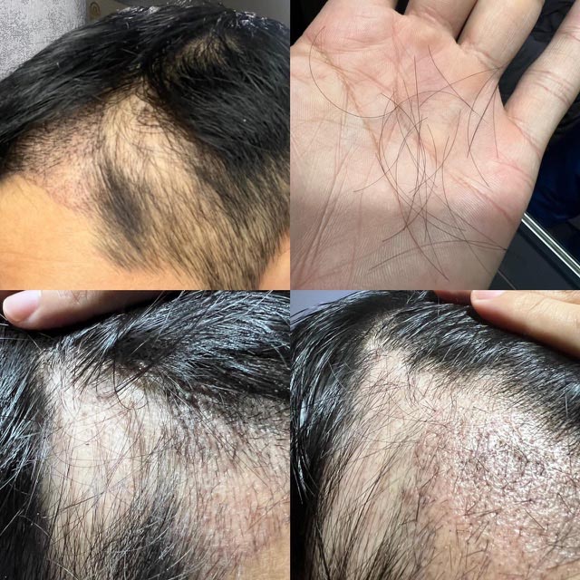 ภาพรีวิวหลังปลูกผม 17 วัน แสดงเส้นผมที่หลุดร่วงบนฝ่ามือและบริเวณแนวผมด้านหน้าที่บางลงในช่วง Shock Loss