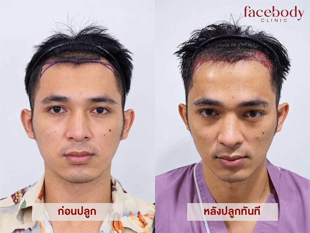 ถ่ายเปรียบเทียบก่อนและหลังปลูกผมทันที (ผลลัพธ์อาจเปลี่ยนแปลงไปตามบุคคล)