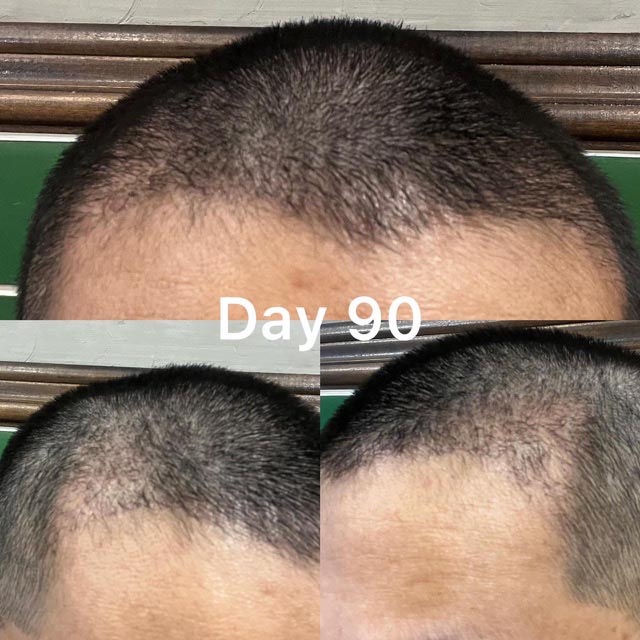 รีวิวปลูกผม 3 เดือน (90 วัน) จากเคสจริง Facebody Clinic แสดงพัฒนาการของแนวผมด้านหน้า หลังผ่านช่วงผมร่วงชั่วคราว เริ่มเห็นเส้นผมสั้นขึ้นและความหนาแน่นที่ยังไม่สม่ำเสมอ