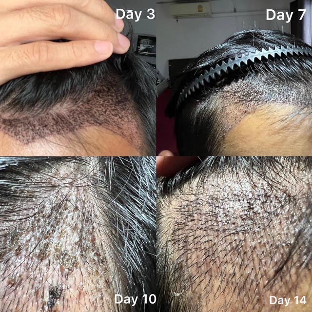 ภาพรีวิวหลังปลูกผม 17 วัน แสดงเส้นผมที่หลุดร่วงบนฝ่ามือและบริเวณแนวผมด้านหน้าที่บางลงในช่วง Shock Loss