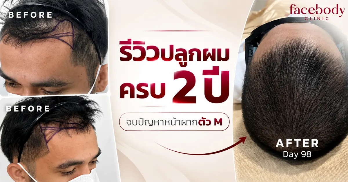 รีวิวปลูกผม 2 ปี บอกลาปัญหาตัวเอ็มแบบถาวร