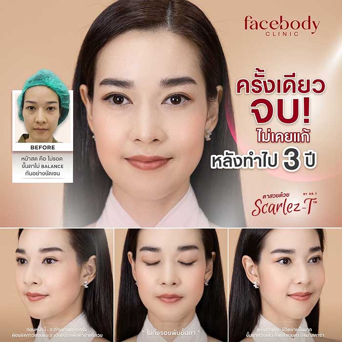 ทำตาสองชั้น ครั้งเดียวจบ