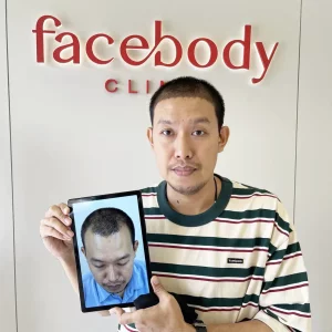 รีวิวปลูกผมถาวร หลังจากอดทนกับ M เว้า 7 ปี​