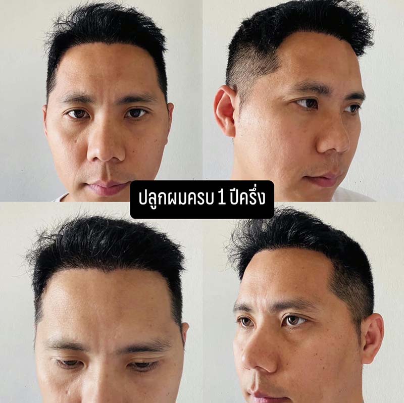 ปลูกผม TIDY Advanced