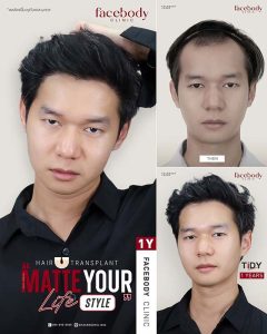 ปลูกผมผู้ชาย-ปลูกผม หนวด คิ้ว เครา หนวด-3