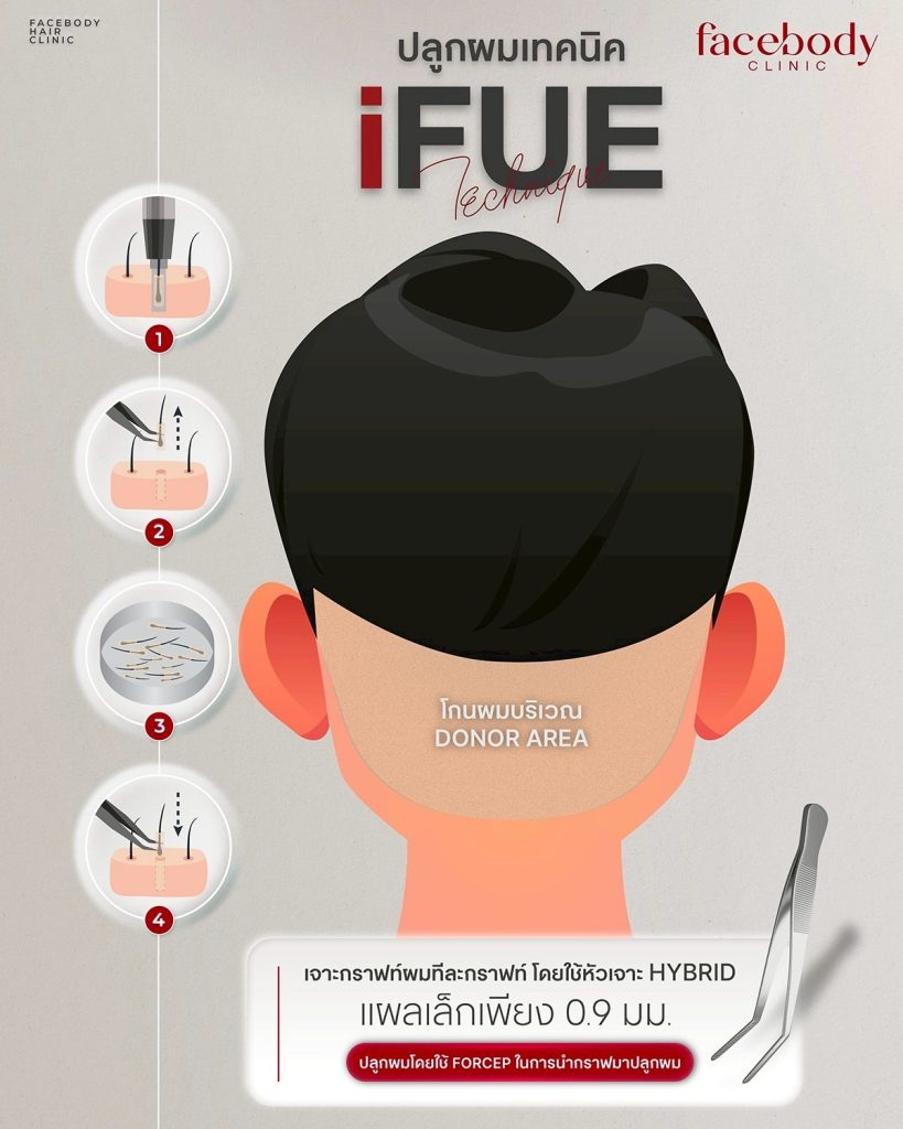           เทคนิคการปลูกผมแบบ iFUE เป็นศัลยกรรมปลูกผมด้วยการย้ายรากผมจากบริเวณท้ายทอยที่มีความแข็งแรงสูงและอัตราการหลุดร่วงน้อยที่สุด ด้วยการย้ายเซลล์รากผมทีละกราฟท์ผมด้วยอุปกรณ์พิเศษ มีแผลขนาดเล็กมาก ไม่ต้องมีแผลผ่าตัดยาว ไร้รอยเย็บแผล พักฟื้นไวกว่าเทคนิคแรก โดยทางเฟสบอดี้ คลินิก มีขั้นตอนและเทคนิคพิเศษเพื่อเพิ่มความหนาแน่นของผมที่ปลูก เพิ่มอัตราการอยู่รอดของเซลล์รากผม และแนวผมที่ขึ้นใหม่ดูเป็นธรรมชาติ