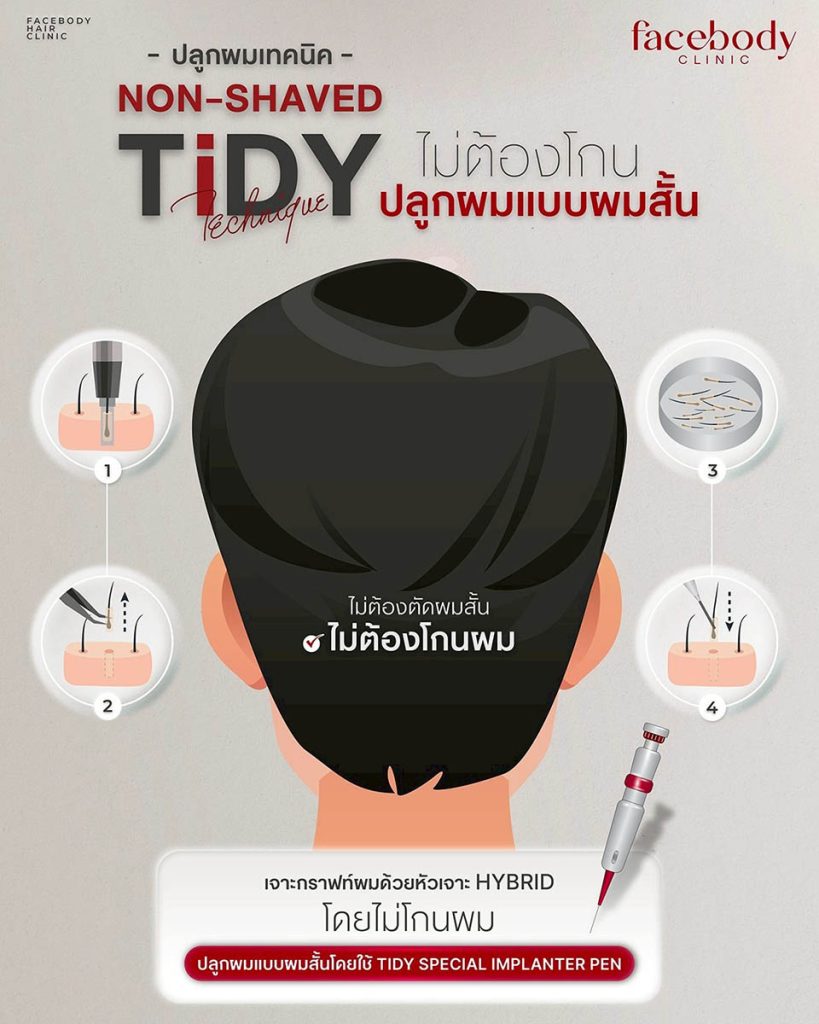 เทคนิคที่ดีกว่ากระบวนการปลูกผมเทคนิค TiDY โดยมีใช้เครื่องมือหัวเจาะขนาดเล็กออกแบบพิเศษที่จะช่วยเพิ่มความสมบูรณ์ของรากผมและลดระยะเวลาพักฟื้น และอุปกรณ์ใส่รากผมชนิดพิเศษ ที่สามารถควบคุมทิศทางแนวไรผมได้อย่างแม่นยำกว่า 