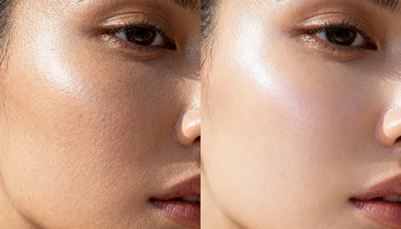 ภาพเปรียบเทียบผิวที่ขาดน้ำกับผิวที่ได้รับการฉีด SKIN Booster จนอิ่มน้ำและดูสุขภาพดี