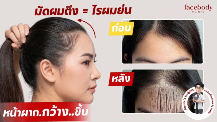 ภาวะ Traction Alopecia ผมร่วงจากการมัดผมตึง Facebody Clinic