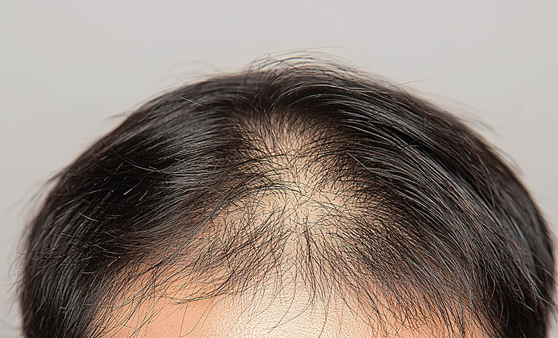 ผมร่วงหลังปลูกผม เกิดจากอะไร? Shock Loss ปกติไหม กี่เดือนขึ้นใหม่ ผมร่วงหลังปลูกผม เกิดจากอะไร? Shock Loss ปกติไหม กี่เดือนขึ้นใหม่