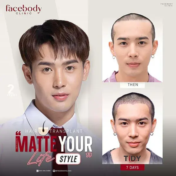 hair transplant 7 days result before after hairline restoration at Facebody Clinic Bangkok