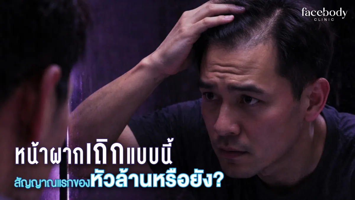 หน้าผากเริ่มเถิก เส้นผมด้านหน้าบางลง หรือรูปทรงไรผมเปลี่ยนไป อาจไม่ใช่แค่เรื่องอายุ แต่คือสัญญาณเริ่มต้นของภาวะผมร่วงจากพันธุกรรม (หัวล้านแบบผู้ชาย – AGA) ที่ควรสังเกตตั้งแต่ระยะเริ่มต้น ยิ่งรู้เร็ว วางแผนรักษาได้ก่อน ลดโอกาสผมบางถาวรในอนาคต
