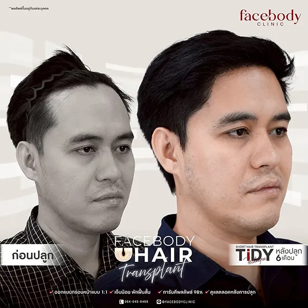 รีวิวปลูกผม FUE 6 เดือน