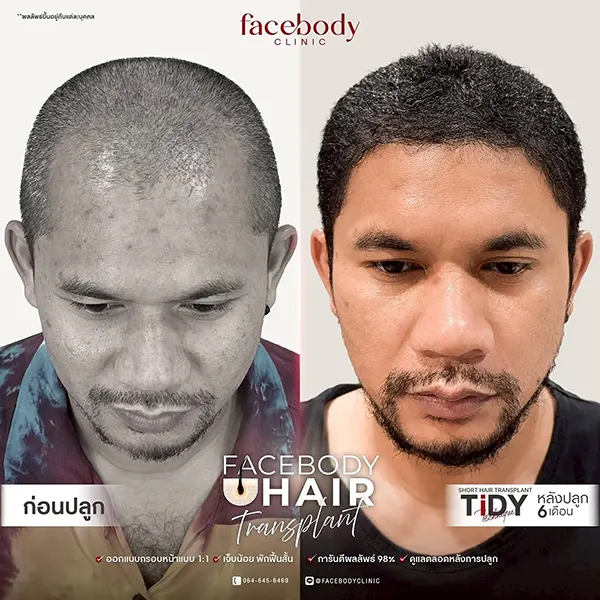 รีวิวปลูกผม FUE 6 เดือน