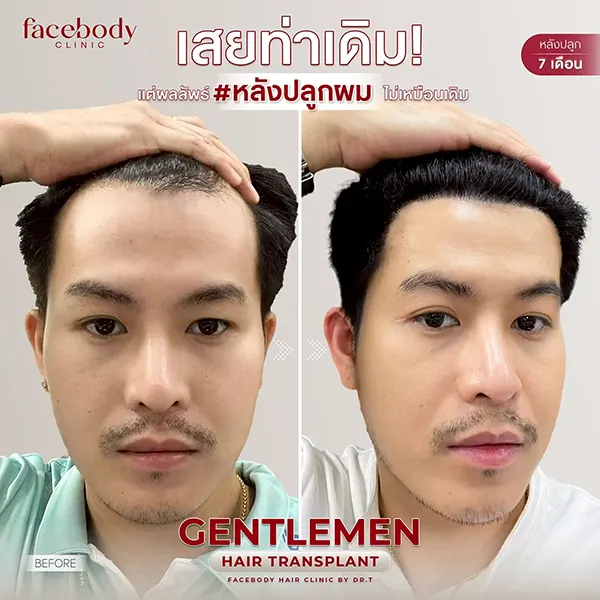 รีวิวปลูกผม FUE 6 เดือน