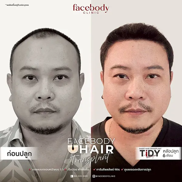 รีวิวปลูกผม FUE 6 เดือน