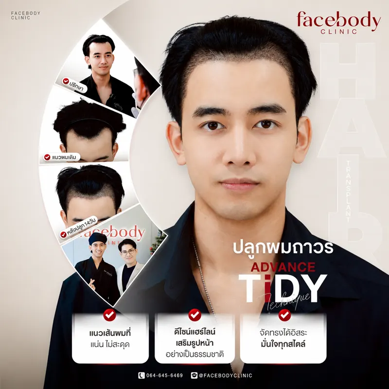 ปลูกผมเทคนิค ADVANCE TiDY รีวิว 14 วัน Facebody Clinic
