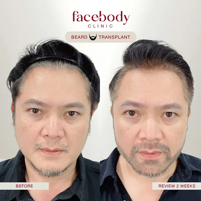 รีวิวปลูกหนวดเครา Facebody Clinic