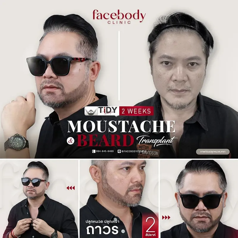 ปลูกผม Non-Shaven FUE ไม่ต้องโกน ก่อน-หลัง Facebody Clinic