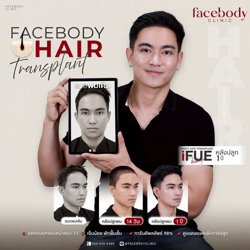 ปลูกผมเทคนิค iFUE ก่อน-หลัง 9 เดือน Facebody Clinic