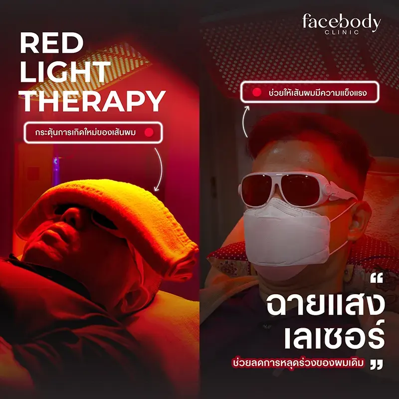 PRP Platelet-Rich Plasma แก้ผมร่วง ผมบาง ก่อน-หลัง 6 ครั้ง Facebody Clinic