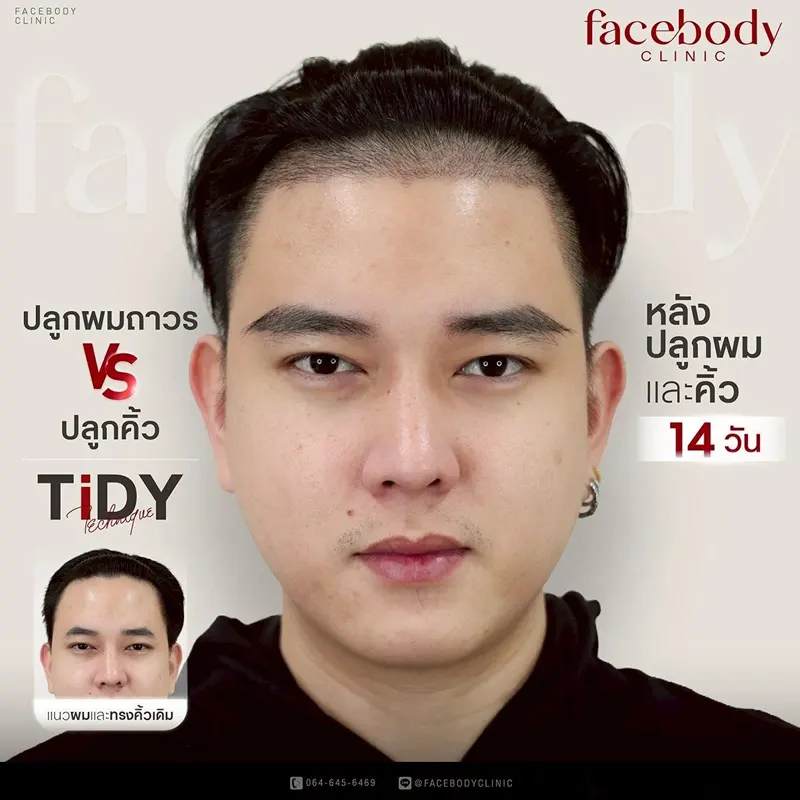 รีวิวปลูกผมและปลูกคิ้ว Facebody Clinic