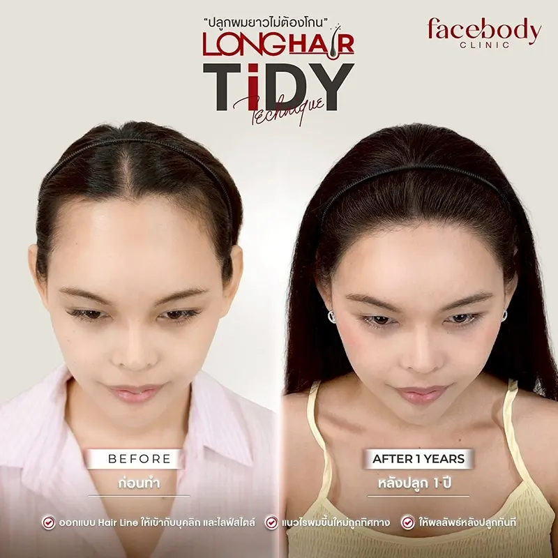 รีวิวปลูกผม Long Hair ครบ 1 ปี