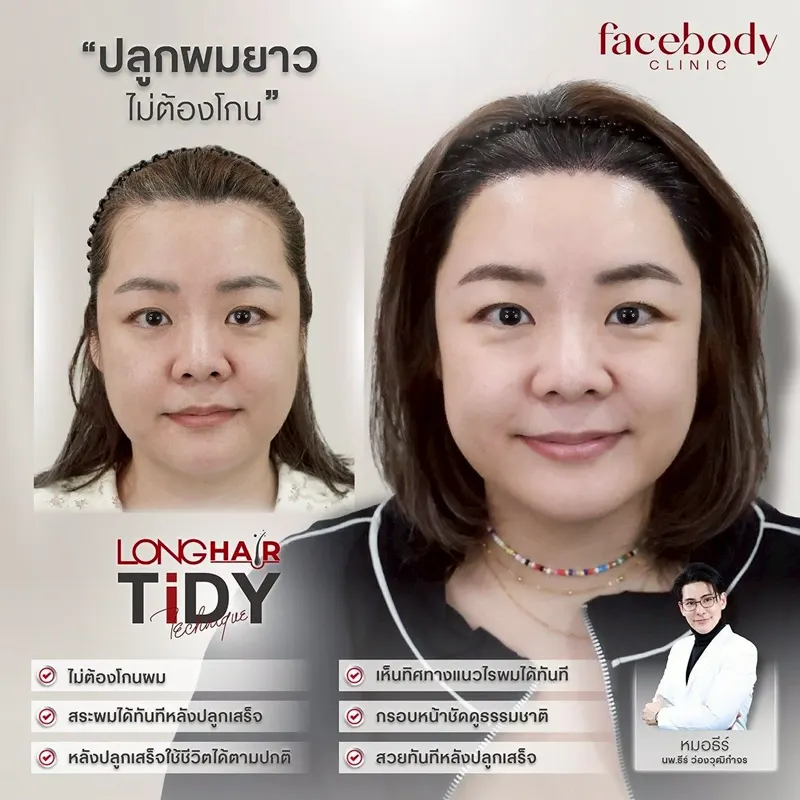 ปลูกผม Long Hair FUE ไม่ต้องโกน ก่อน-หลัง Facebody Clinic