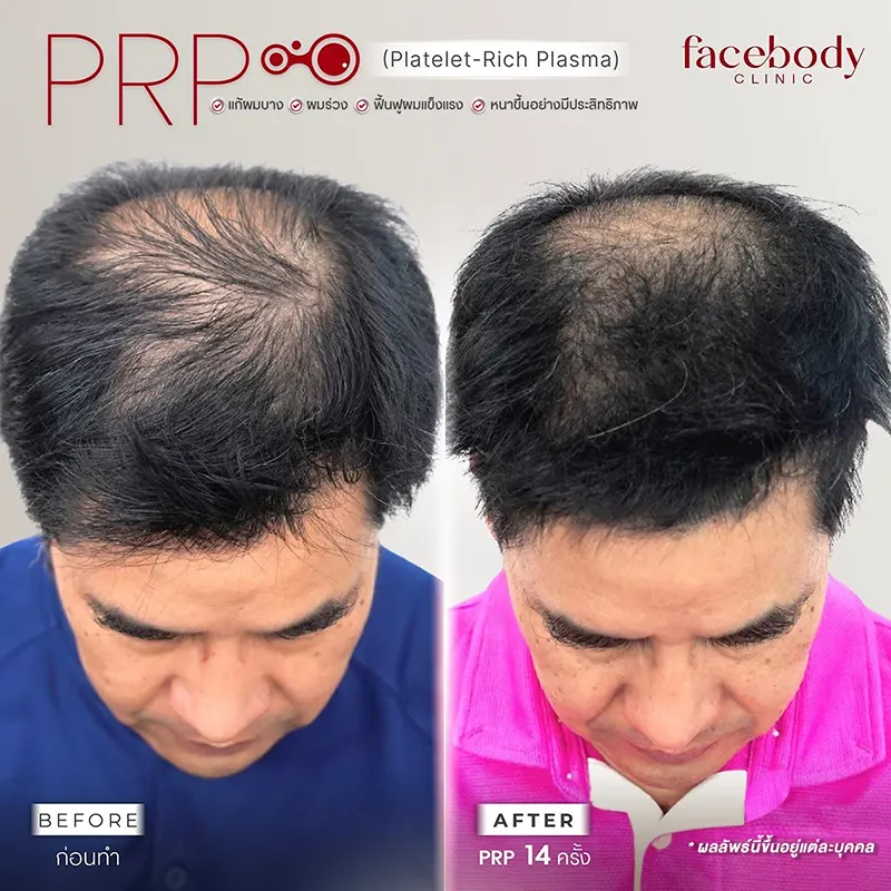 PRP Hair Treatment Facebody Clinic