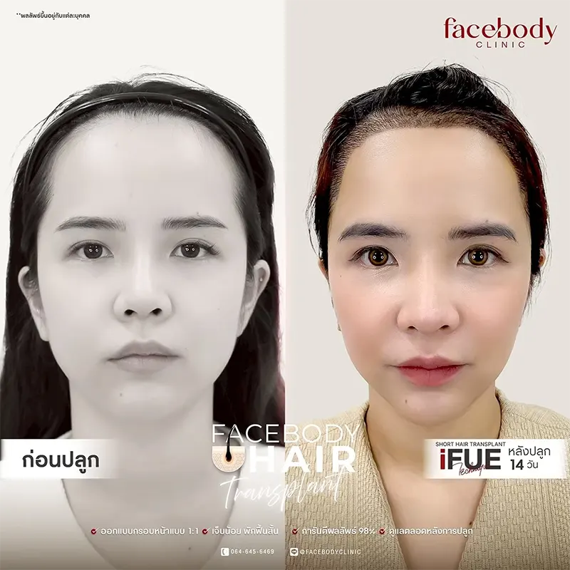 รีวิวปลูกผมก่อนหลัง FUE Facebody Clinic