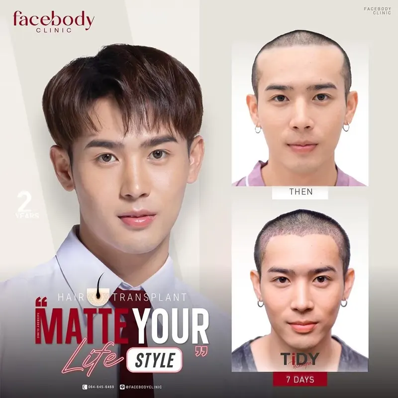 ปลูกหนวด เครา ปลูกผมเทคนิค TiDY ก่อน-หลัง 1 ปี Facebody Clinic