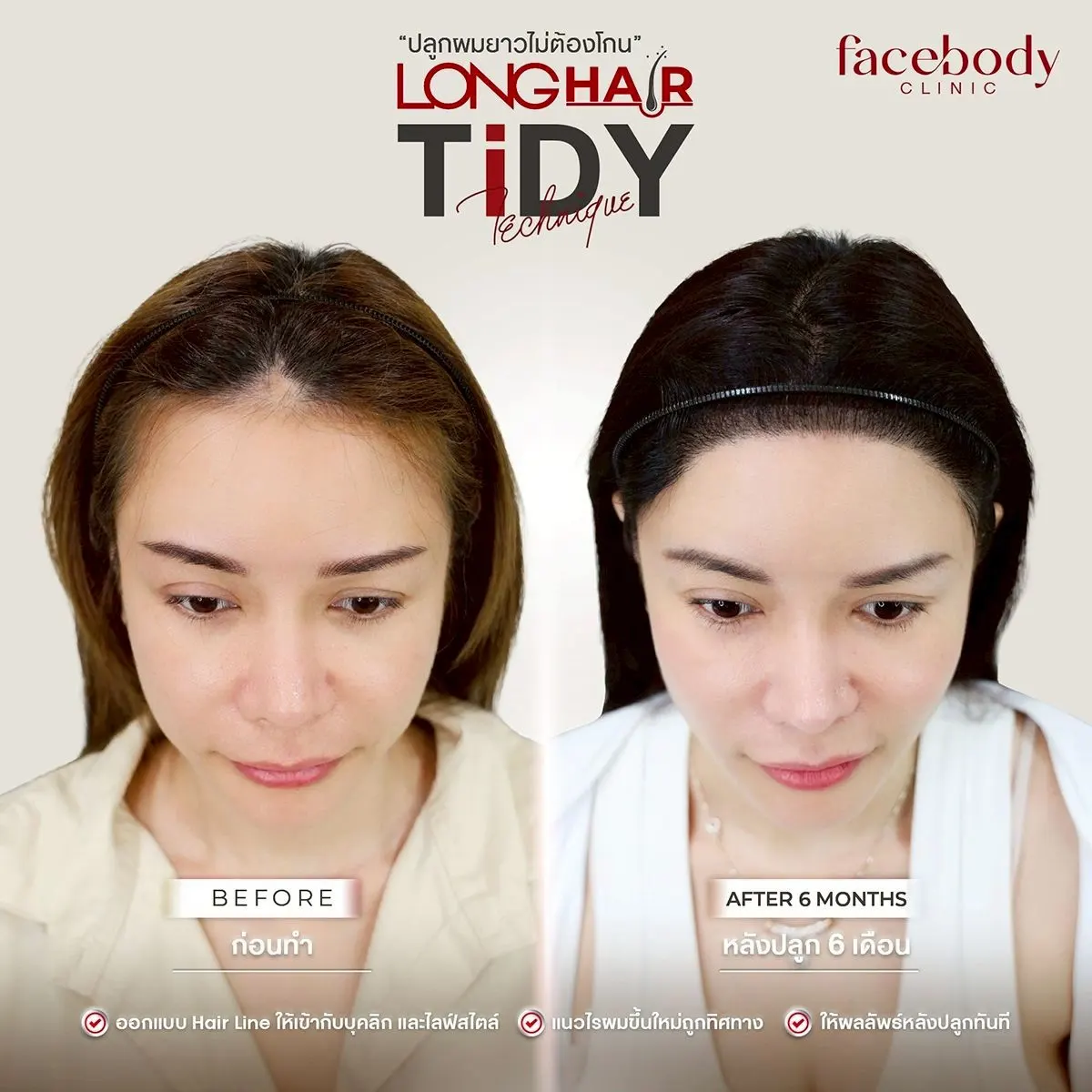 รีวิวปลูกผมก่อนหลัง แนวไรผมธรรมชาติ